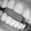 Biting - MAS+